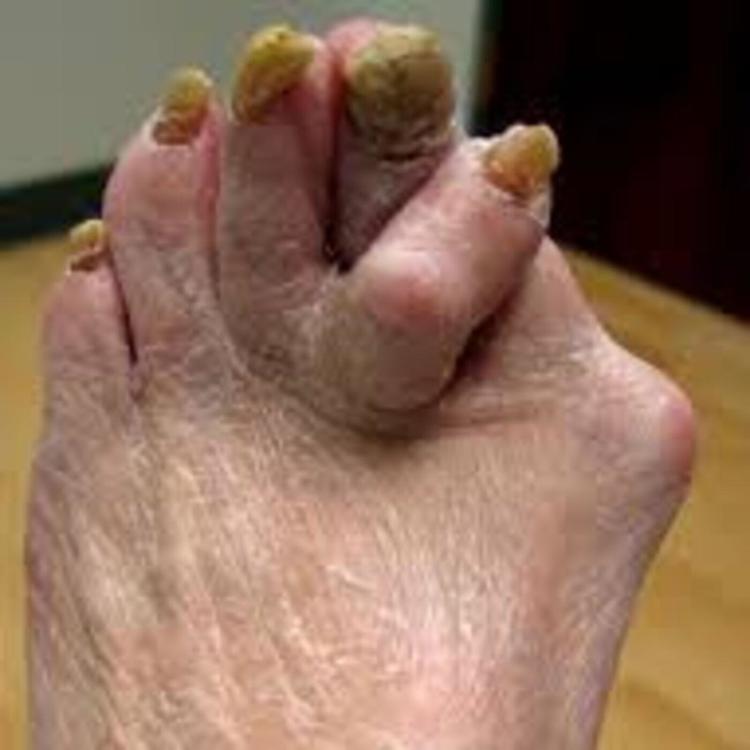 finding-the-most-ugly-feet-oBAJtNjzhLC-Fumxz5Q4h2o.1400x1400.jpg